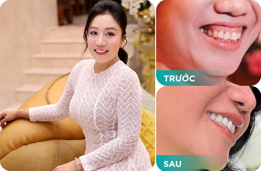 phục hình khuôn miệng