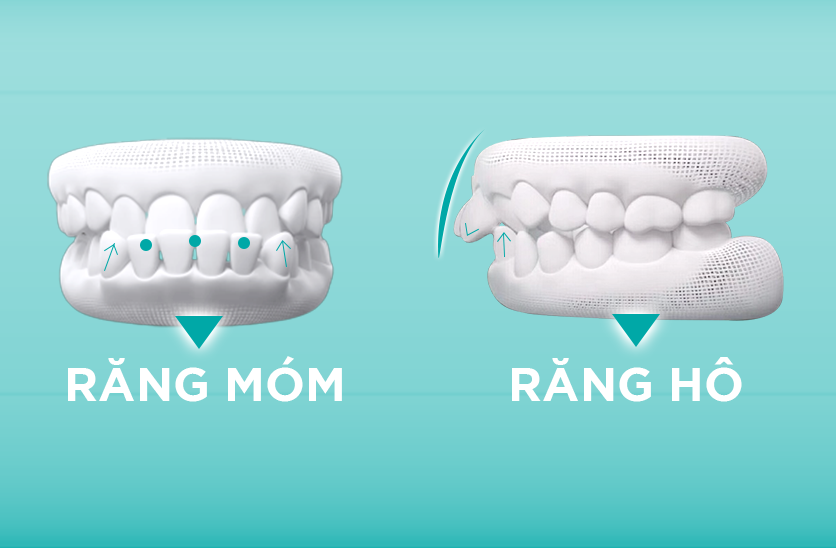 phục hình khuôn miệng