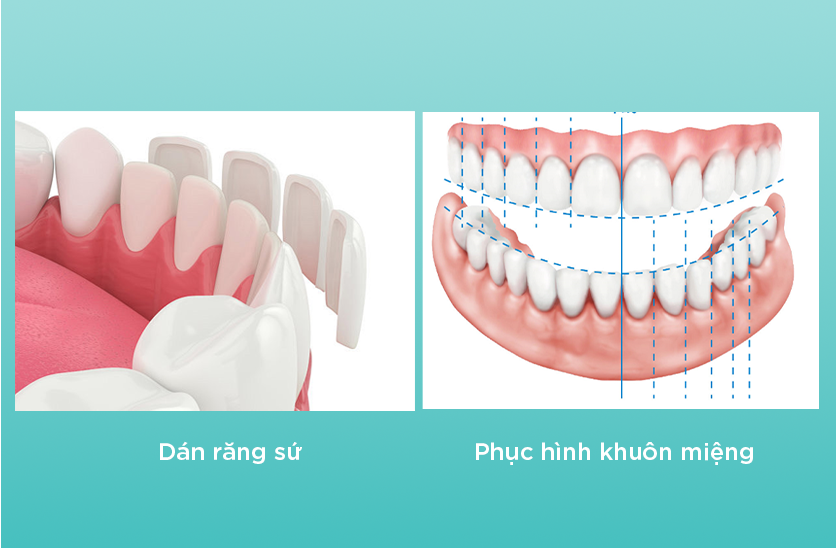 phục hình khuôn miệng