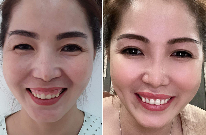 phục hình khuôn miệng