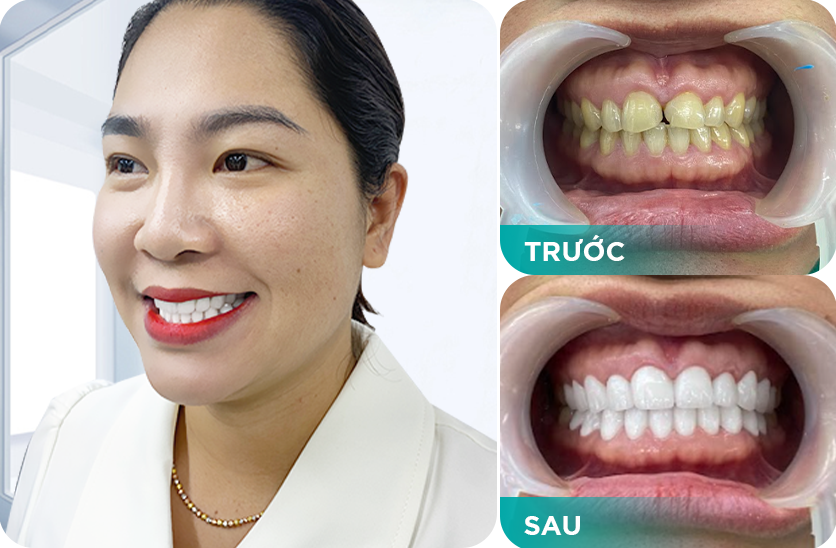 phục hình răng sứ