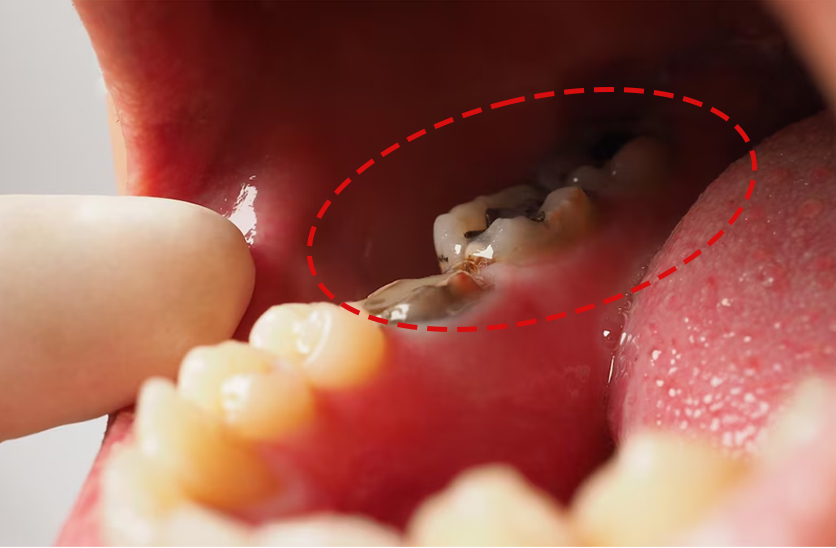 phục hình răng sứ