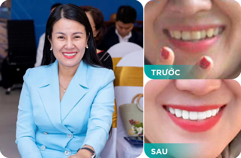 răng sứ kim cương