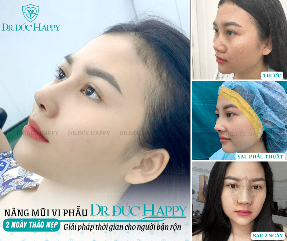 Nâng mũi bao lâu tháo nẹp