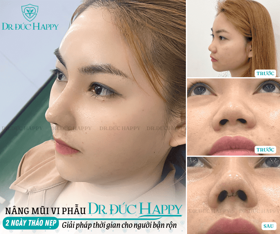 Nâng mũi bao lâu tháo nẹp