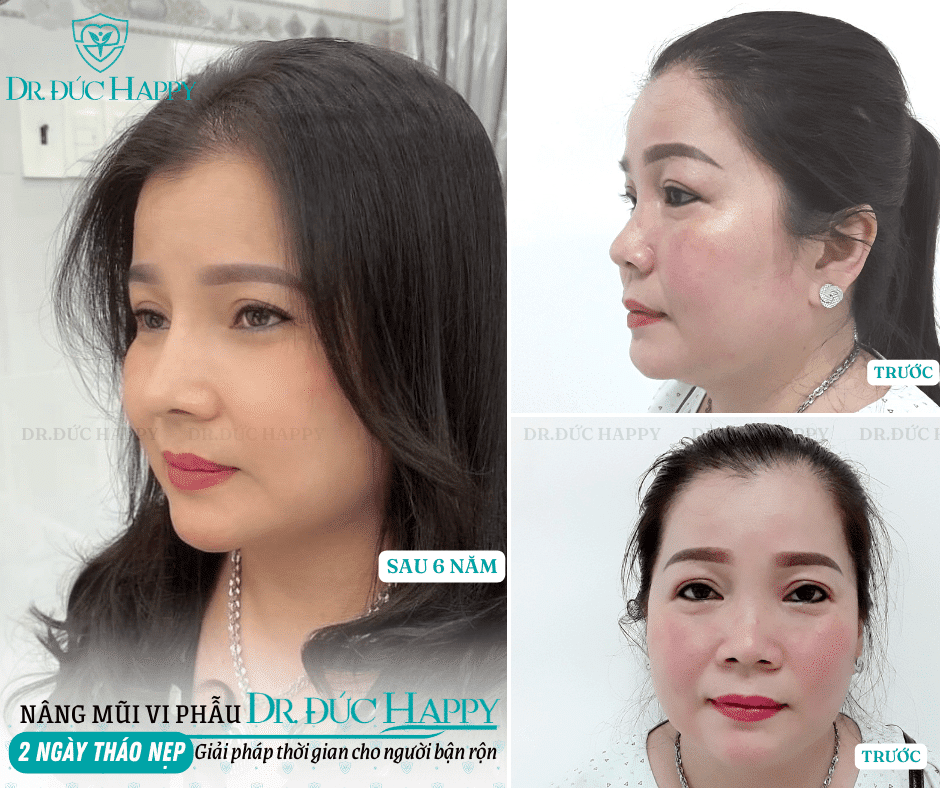 Nâng mũi bao lâu tháo nẹp
