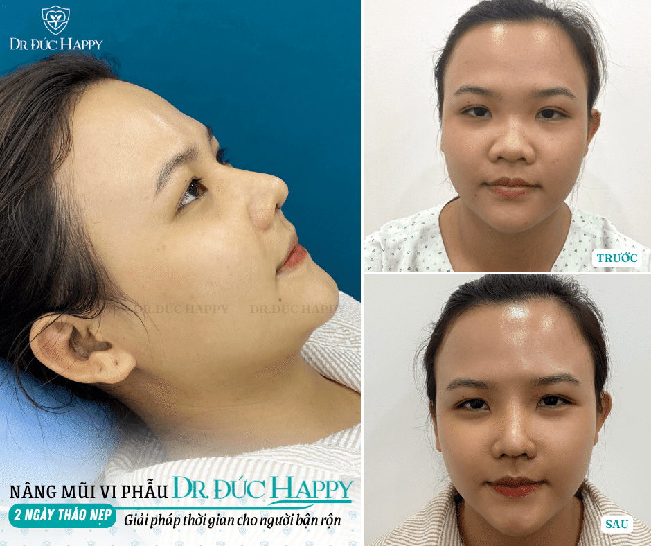 Nâng mũi bao lâu tháo nẹp