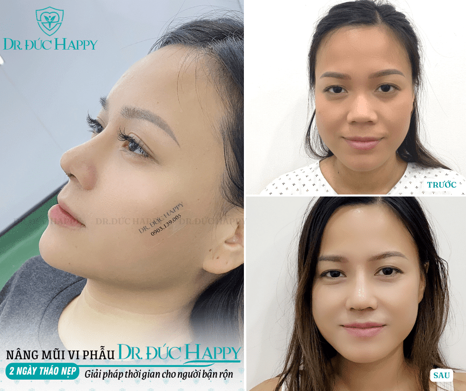 Nâng mũi bao lâu tháo nẹp