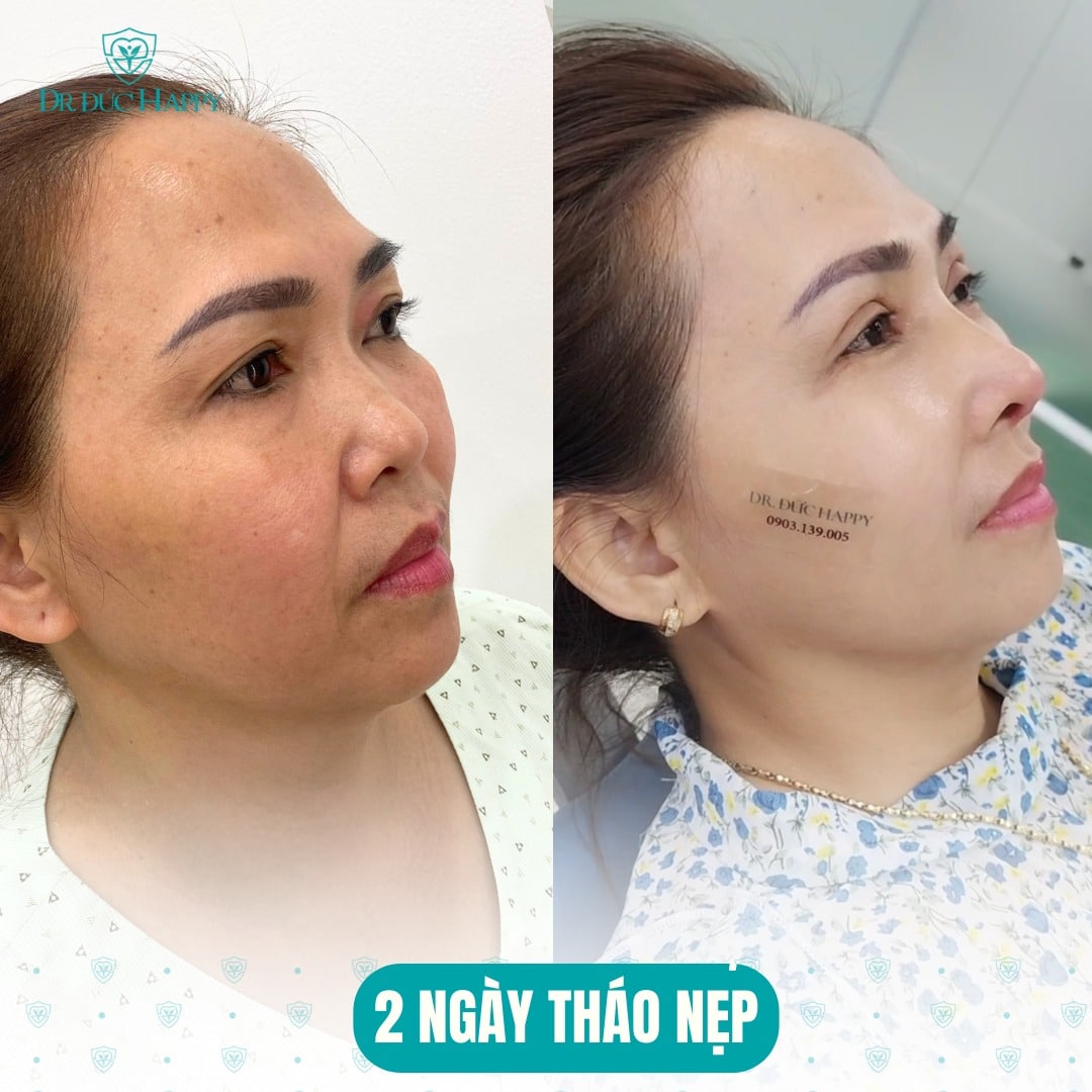 Nâng mũi bao lâu tháo nẹp