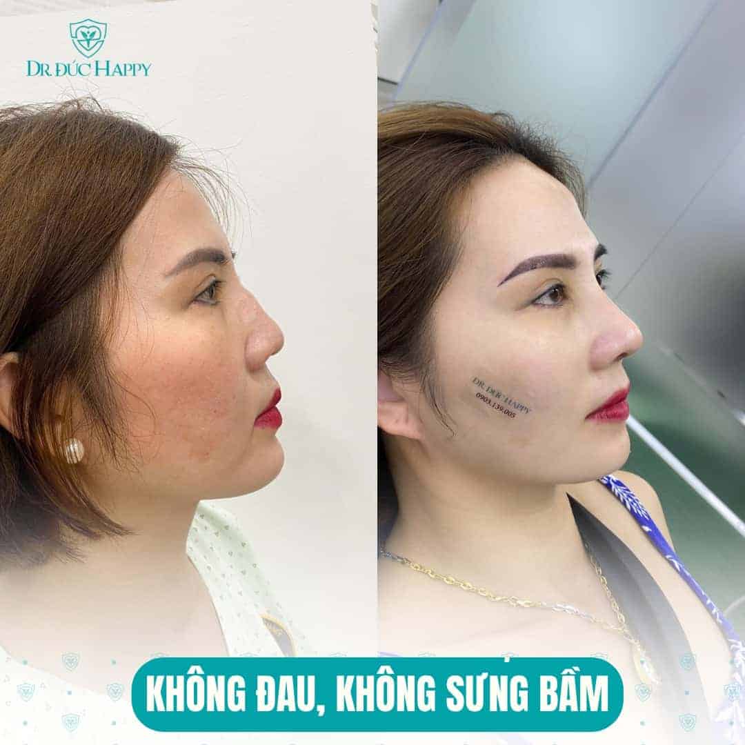 Nâng mũi bao lâu tháo nẹp