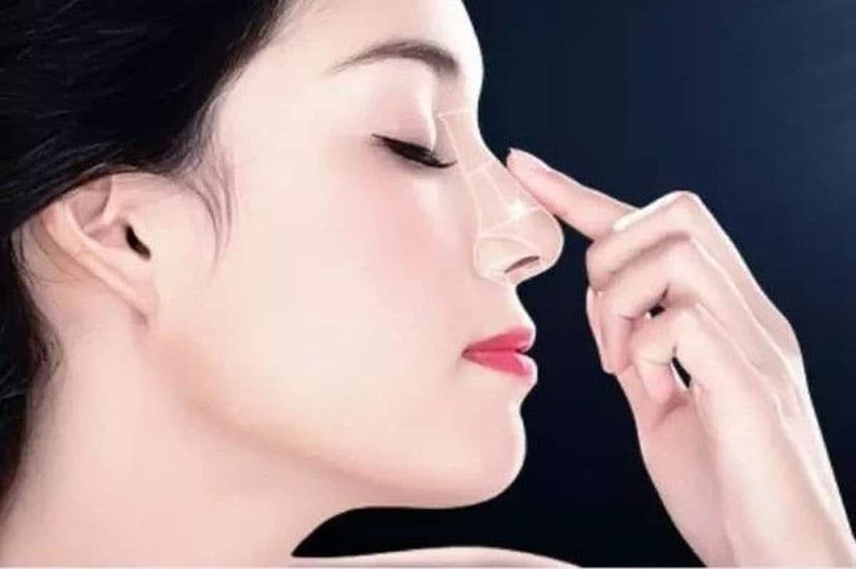 nâng mũi mấy ngày tháo nẹp