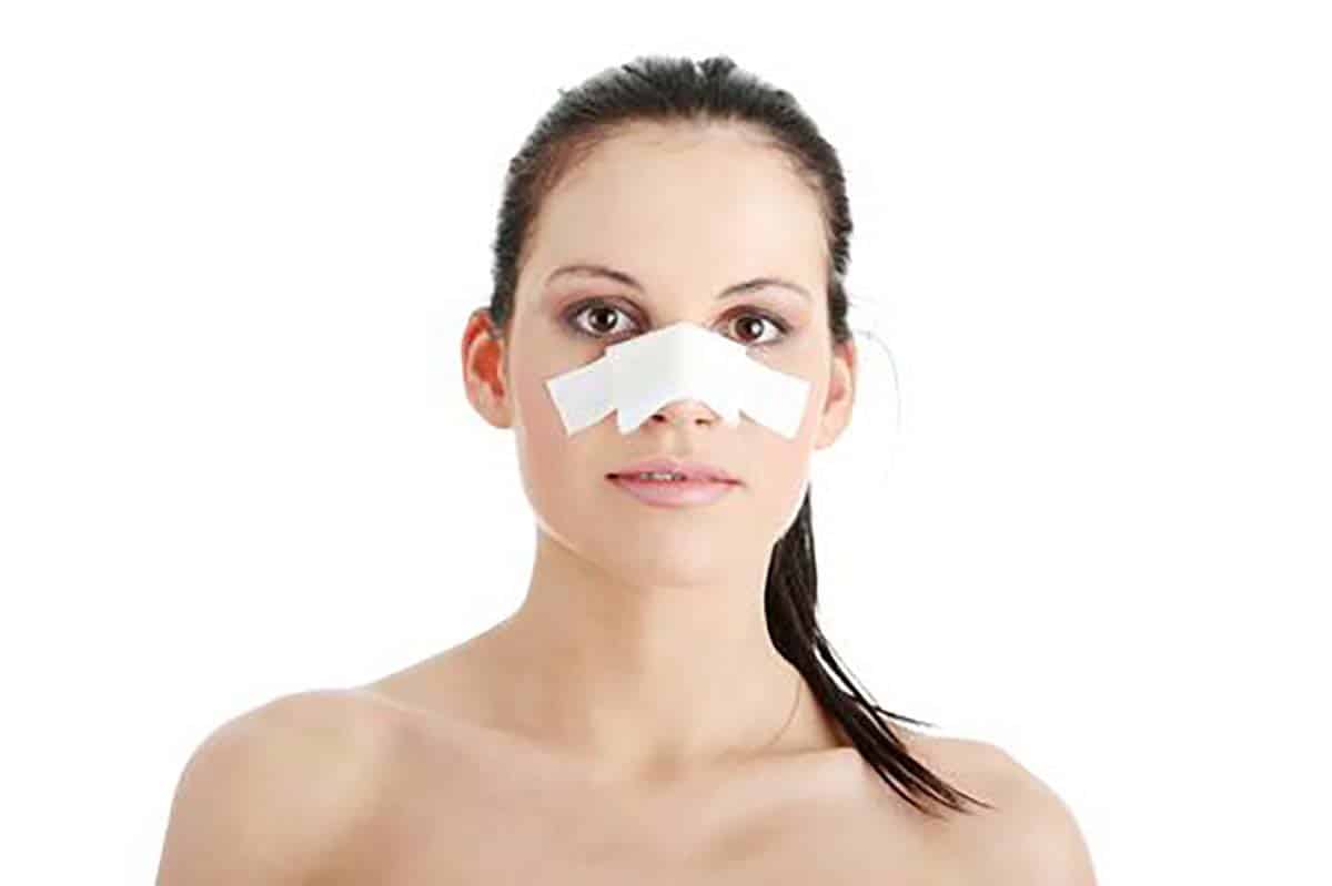 nâng mũi mấy ngày tháo nẹp