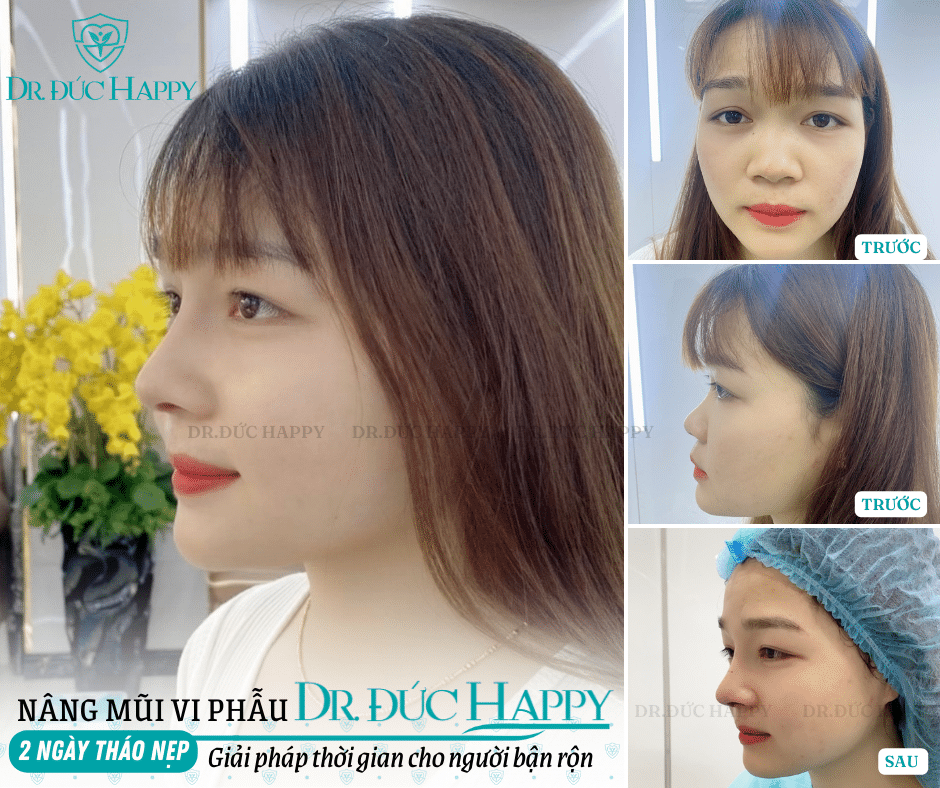 nâng mũi mấy ngày tháo nẹp
