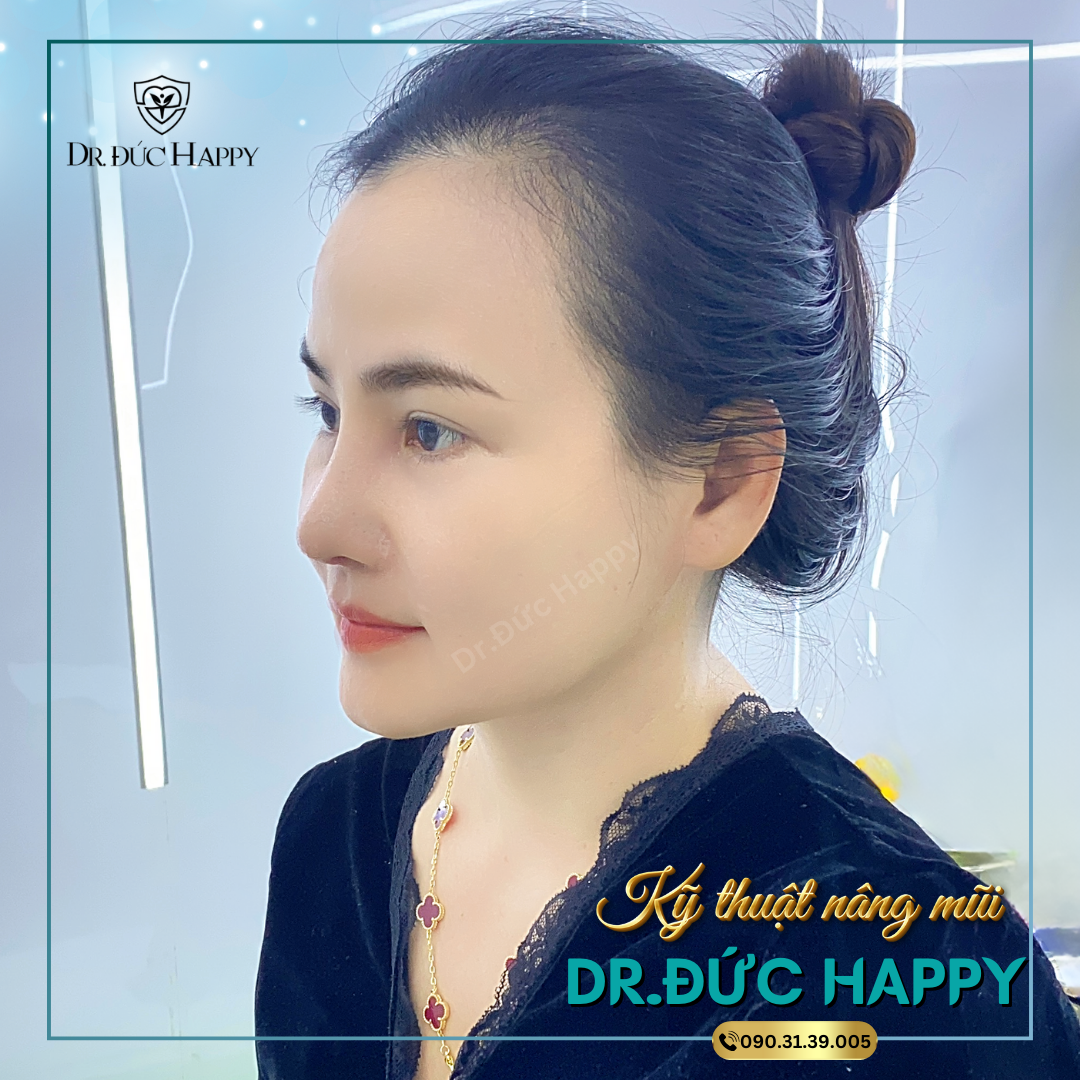 nâng mũi vi phẩu