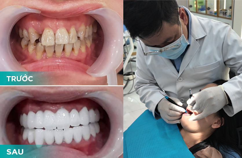 răng sứ kim cương loại nào tốt