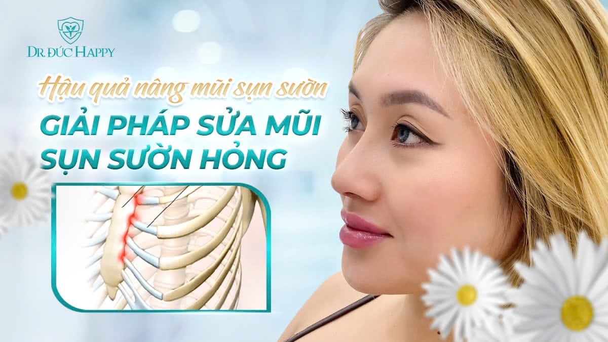 sửa mũi sụn sườn hỏng