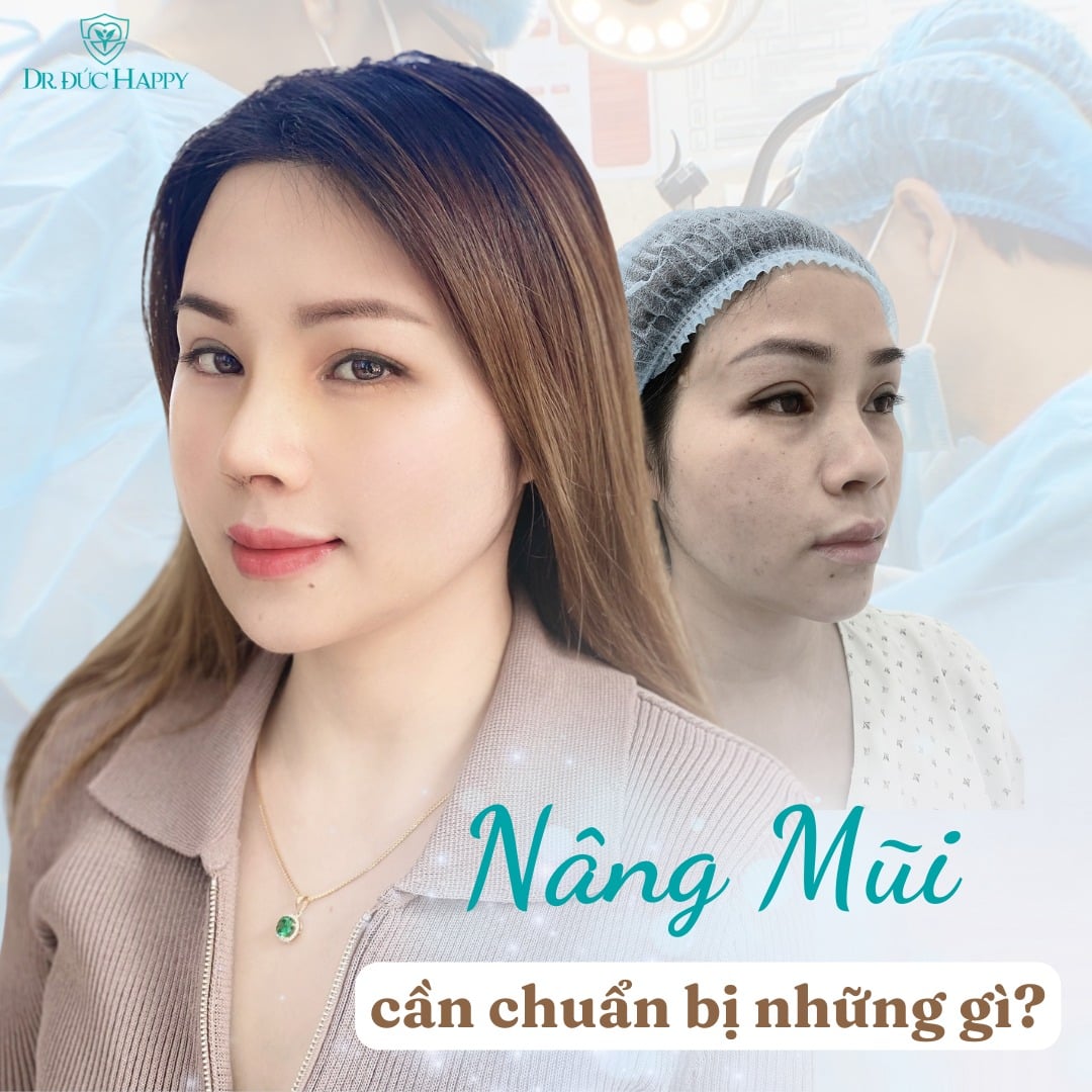 sửa mũi sụn sườn hỏng