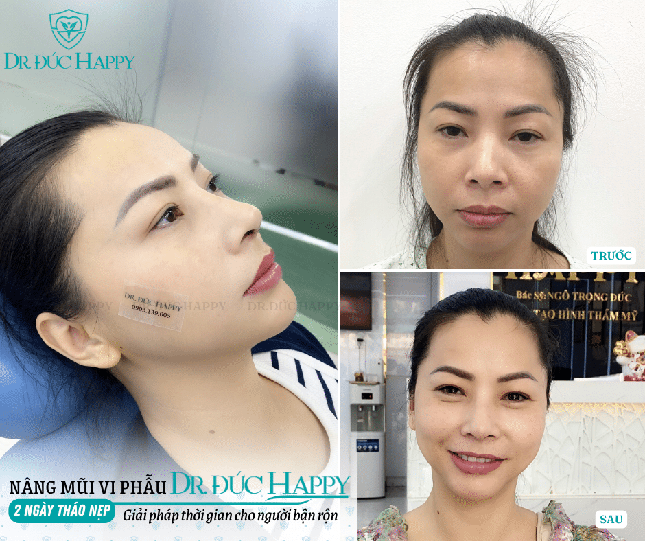 tháo nẹp mũi sau một tuần có được không