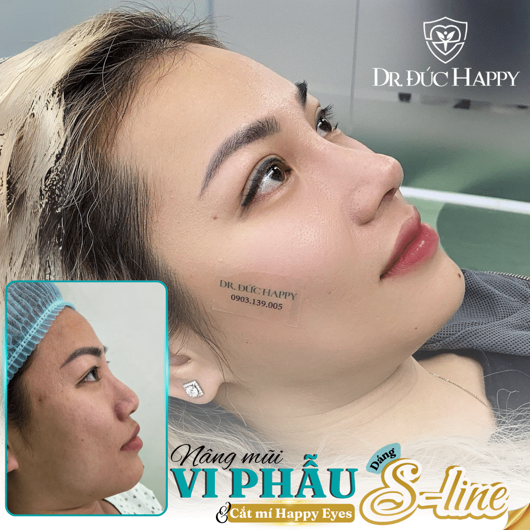 nâng mũi mấy ngày tháo nẹp