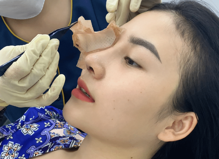 nâng mũi mấy ngày tháo nẹp
