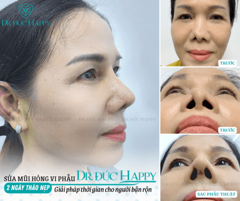 Bác sĩ phẫu thuật sửa mũi hỏng