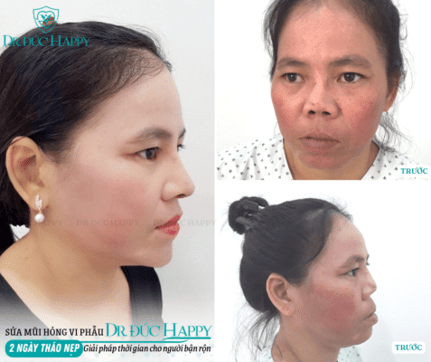 Bác sĩ phẫu thuật sửa mũi hỏng